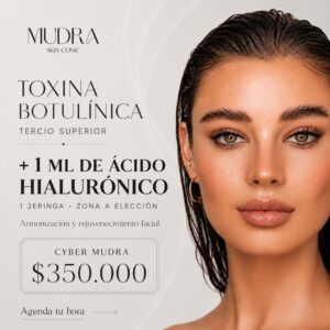CYBER Botox tercio superior + Acido Hialurónico 1 ML